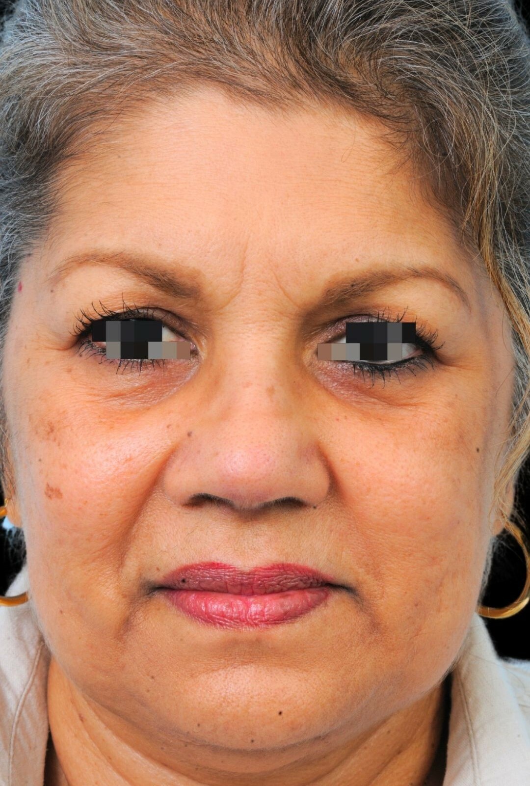 Photo of the patient’s after the Rhinoplasty Patient 11