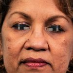 Thumbnail photo of the patient’s before the Rhinoplasty Patient 11