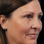 Thumbnail photo of the patient’s after the Rhinoplasty Patient 12