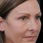 Thumbnail photo of the patient’s before the Rhinoplasty Patient 12