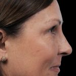 Thumbnail photo of the patient’s after the Rhinoplasty Patient 12