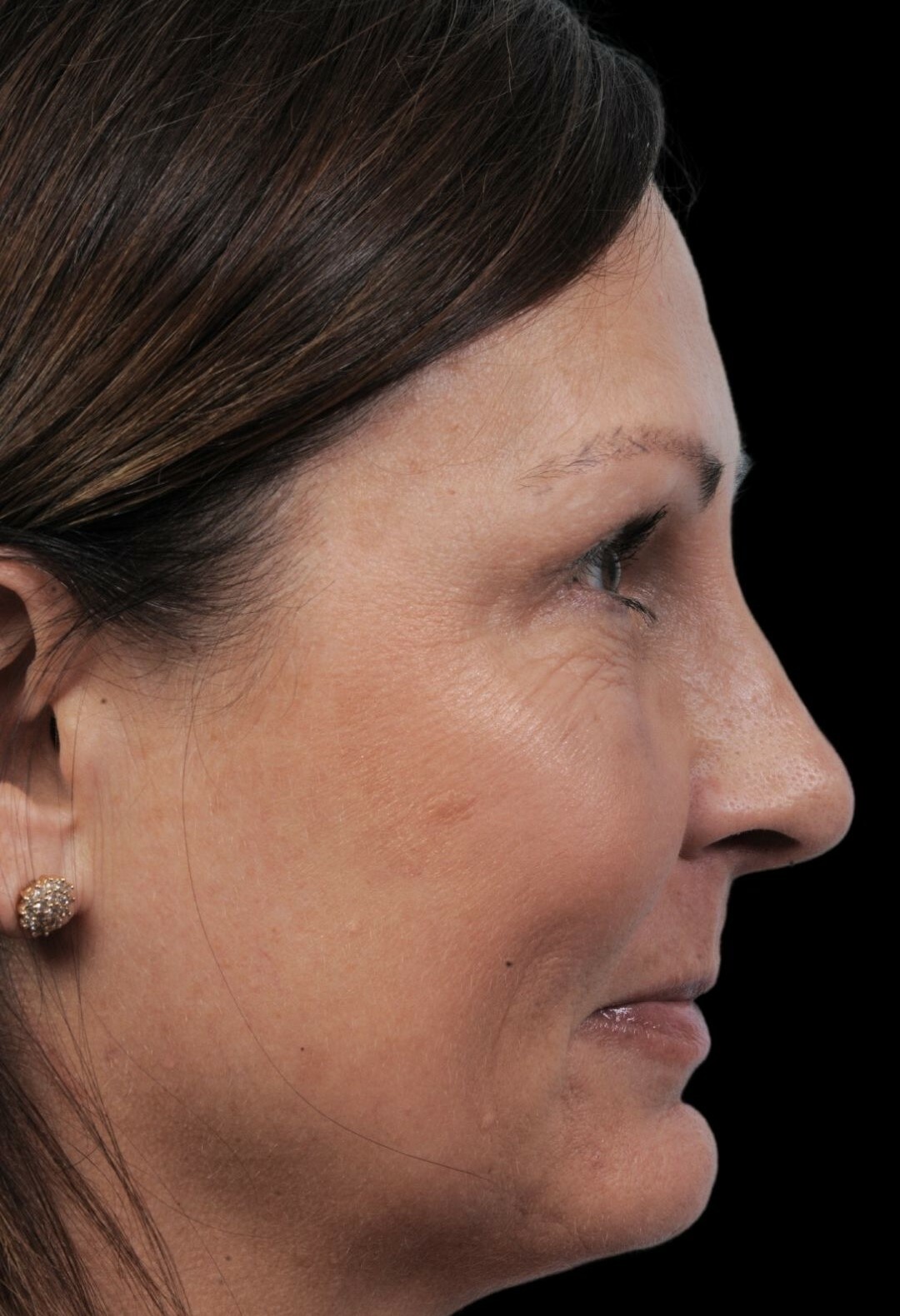 Photo of the patient’s face after the Rhinoplasty surgery. Patient 12 - Set 1