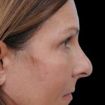 Thumbnail photo of the patient’s before the Rhinoplasty Patient 12