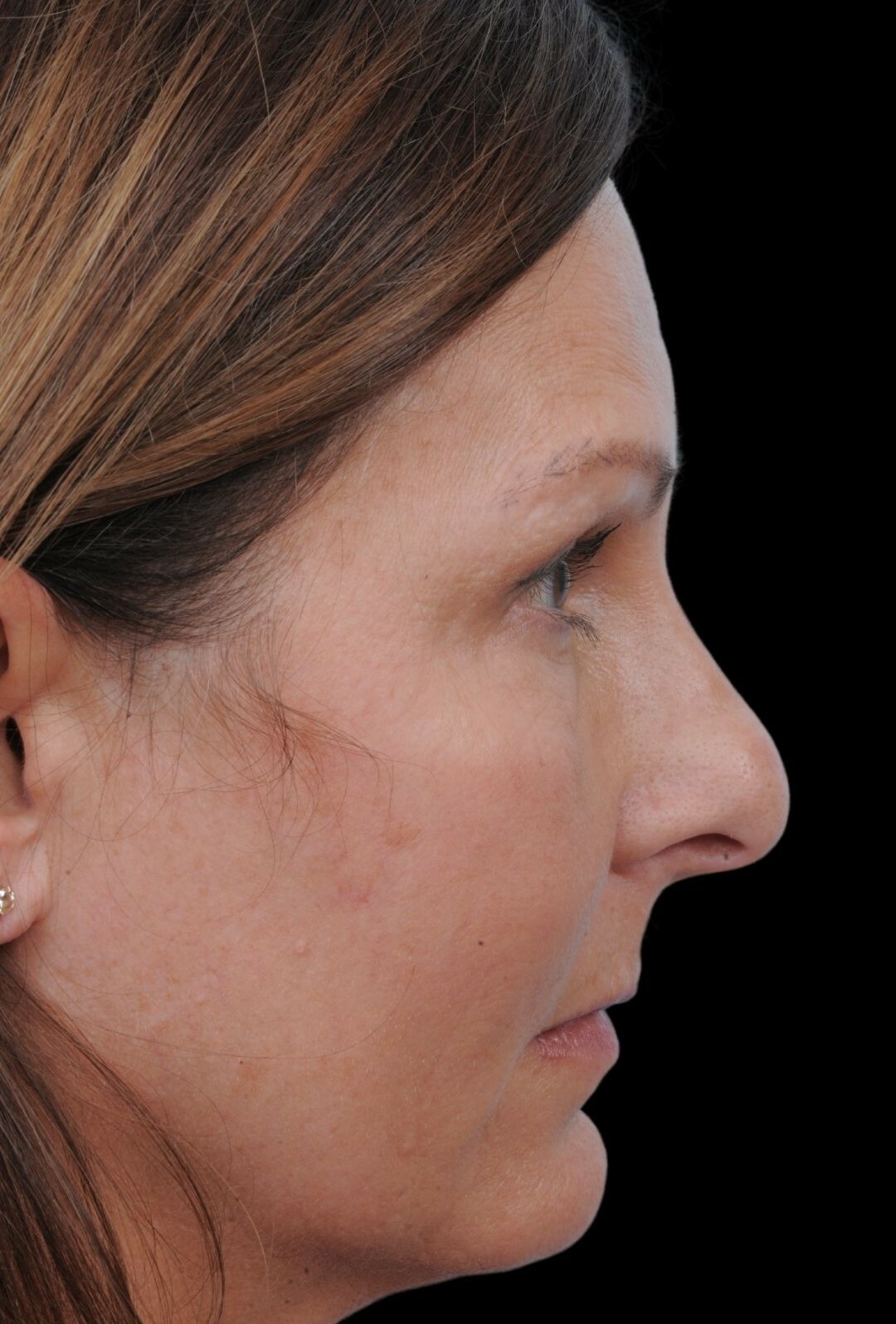 Photo of the patient’s face before the Rhinoplasty surgery. Patient 12 - Set 1
