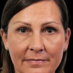 Thumbnail photo of the patient’s after the Rhinoplasty Patient 12