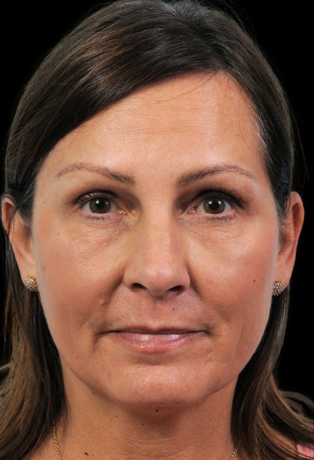 Photo of the patient’s after the Rhinoplasty Patient 12