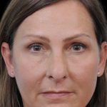 Thumbnail photo of the patient’s before the Rhinoplasty Patient 12