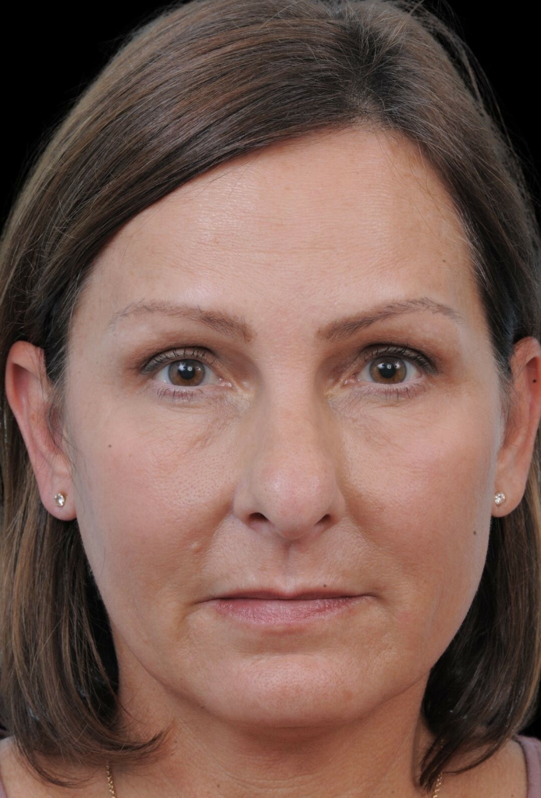 Photo of the patient’s before the Rhinoplasty Patient 12