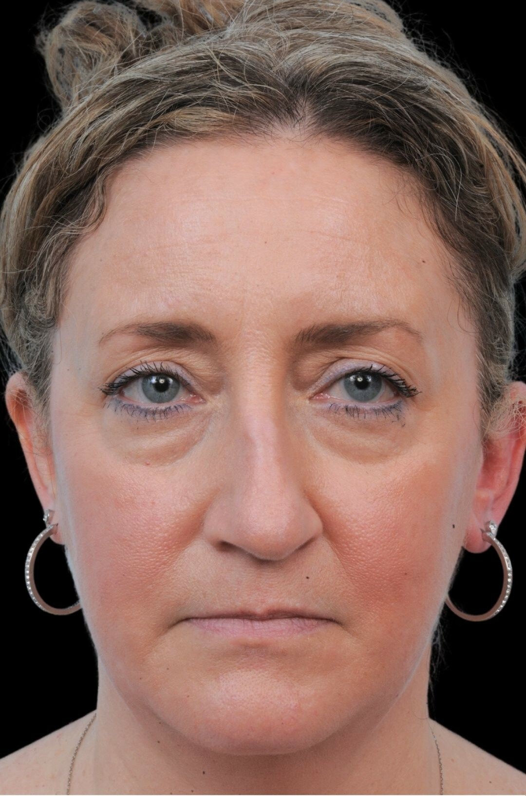 Photo of the patient’s face before the Rhinoplasty surgery. Patient 2 - Set 3