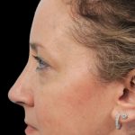 Thumbnail photo of the patient’s after the Rhinoplasty Patient 2