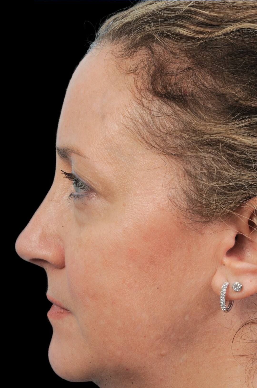 Photo of the patient’s face after the Rhinoplasty surgery. Patient 2 - Set 2