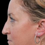 Thumbnail photo of the patient’s before the Rhinoplasty Patient 2