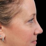 Thumbnail photo of the patient’s after the Rhinoplasty Patient 2