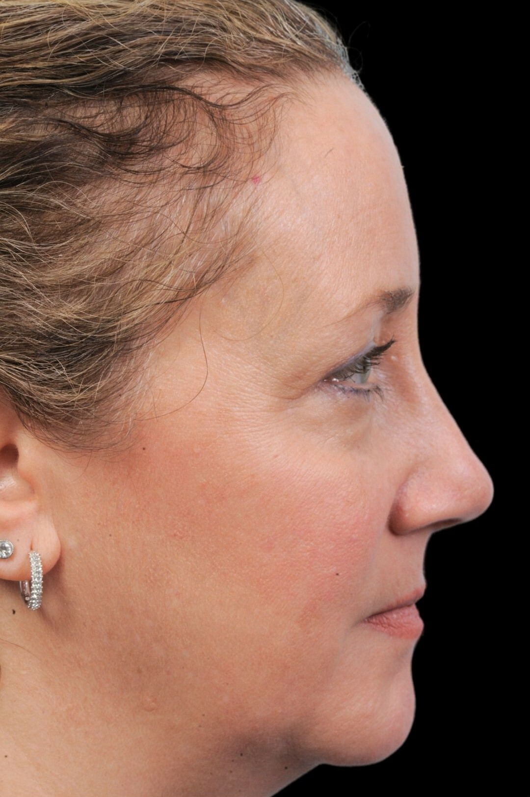 Photo of the patient’s after the Rhinoplasty Patient 2