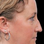 Thumbnail photo of the patient’s before the Rhinoplasty Patient 2