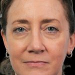 Thumbnail photo of the patient’s after the Rhinoplasty Patient 2