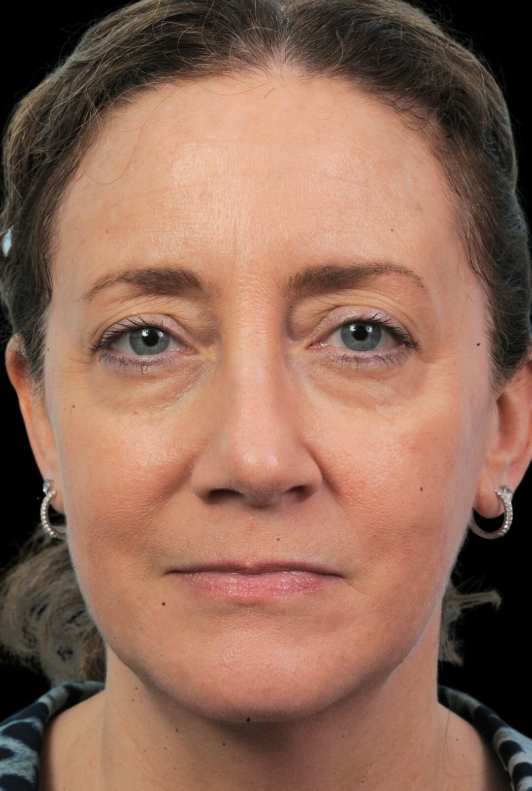Photo of the patient’s after the Rhinoplasty Patient 2