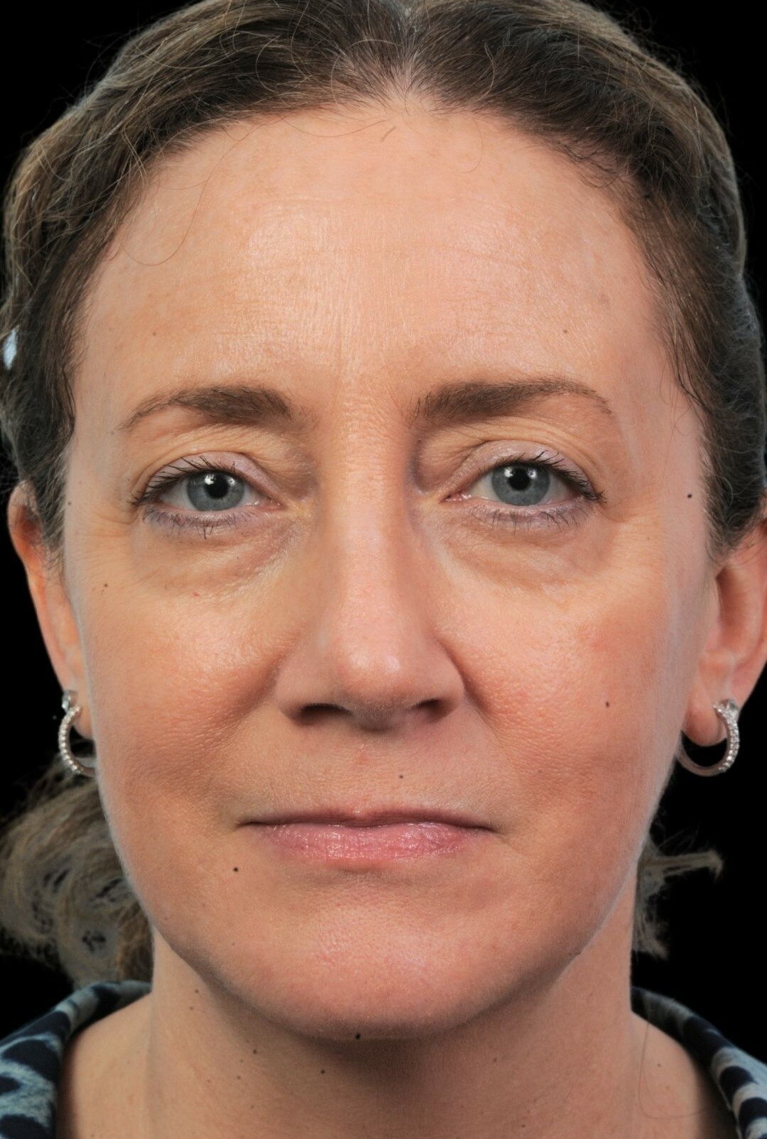 Photo of the patient’s face after the Rhinoplasty surgery. Patient 2 - Set 3