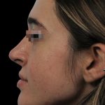 Thumbnail photo of the patient’s after the Rhinoplasty Patient 13