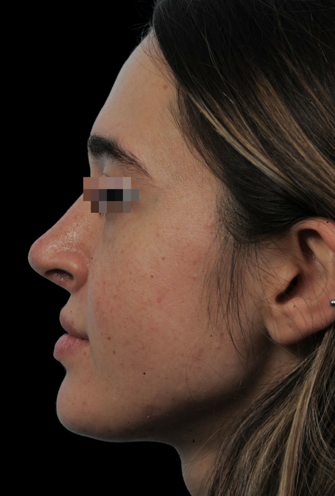 Photo of the patient’s face after the Rhinoplasty surgery. Patient 13 - Set 2