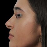 Thumbnail photo of the patient’s before the Rhinoplasty Patient 13