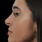 Photo of the patient’s face before the Rhinoplasty surgery. Patient 13 - Set 2