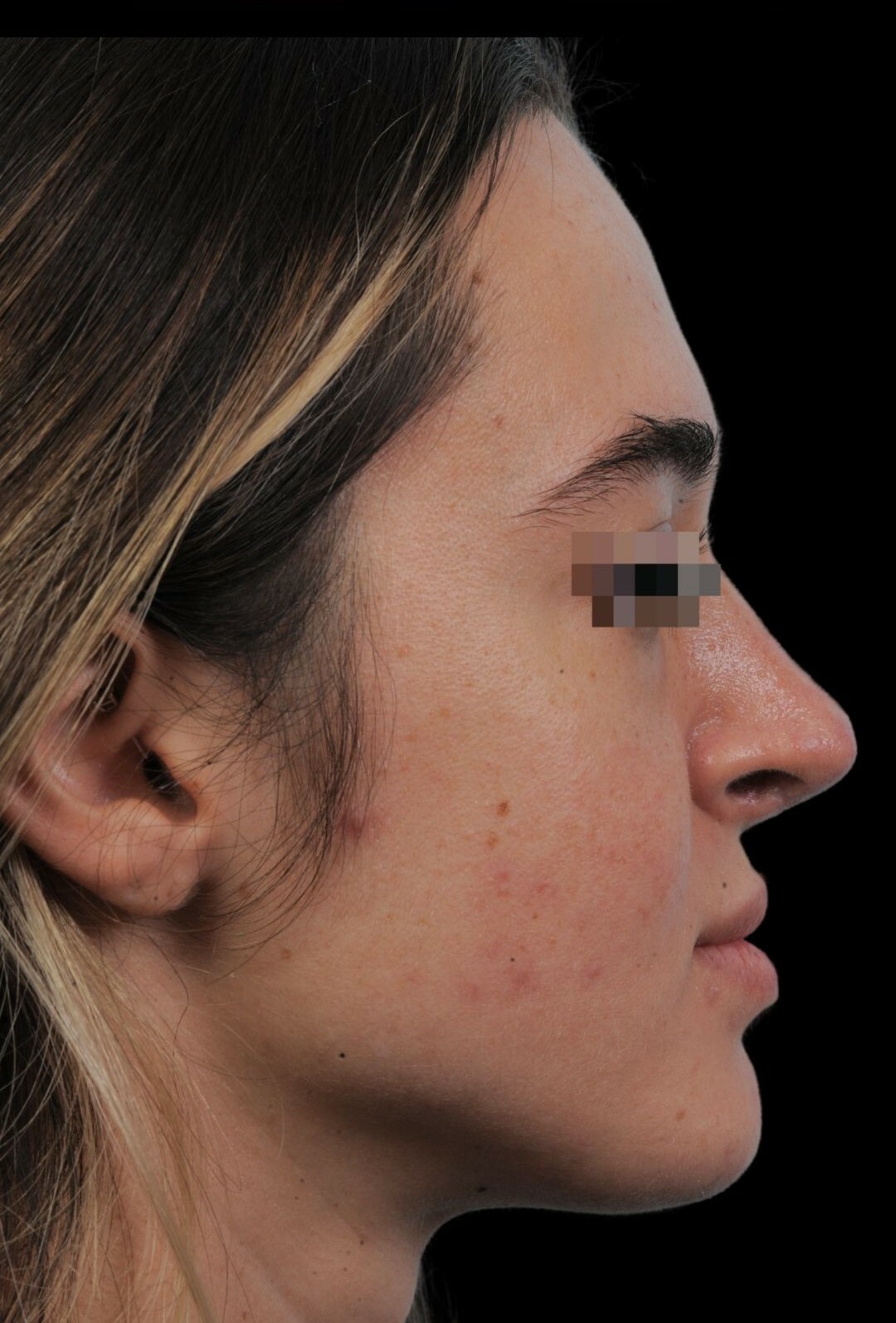 Photo of the patient’s face after the Rhinoplasty surgery. Patient 13 - Set 1