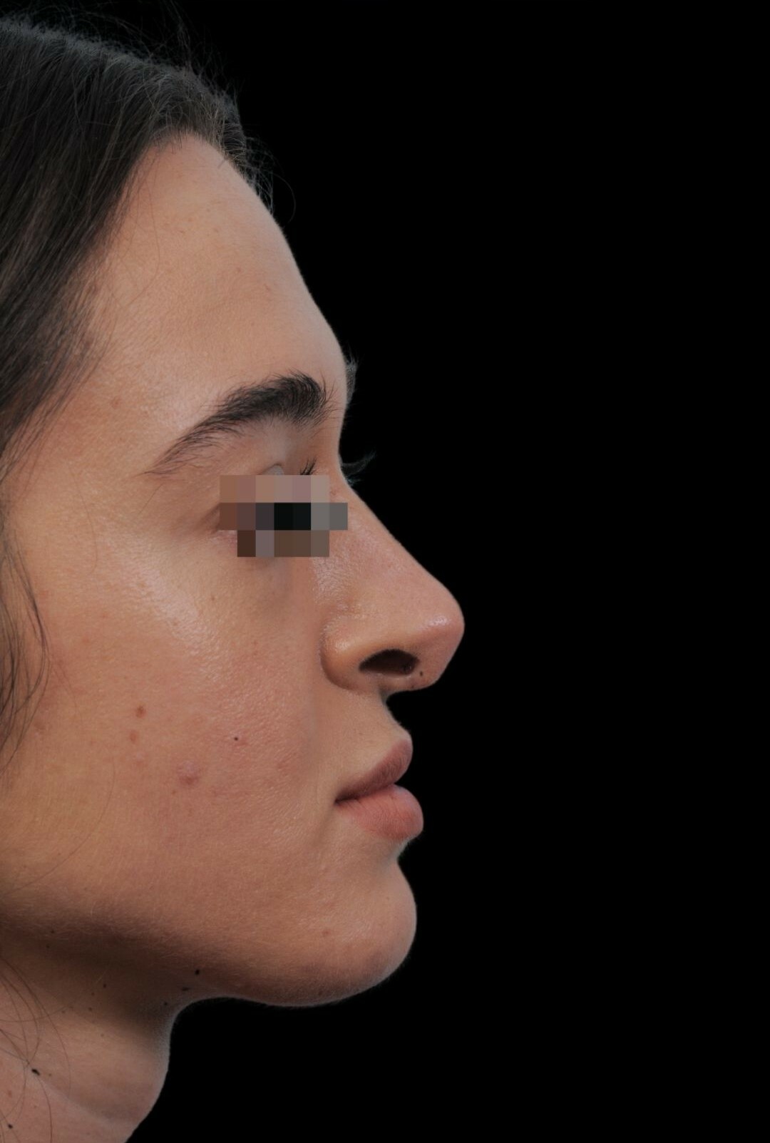 Photo of the patient’s face before the Rhinoplasty surgery. Patient 13 - Set 1