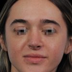 Thumbnail photo of the patient’s after the Rhinoplasty Patient 13
