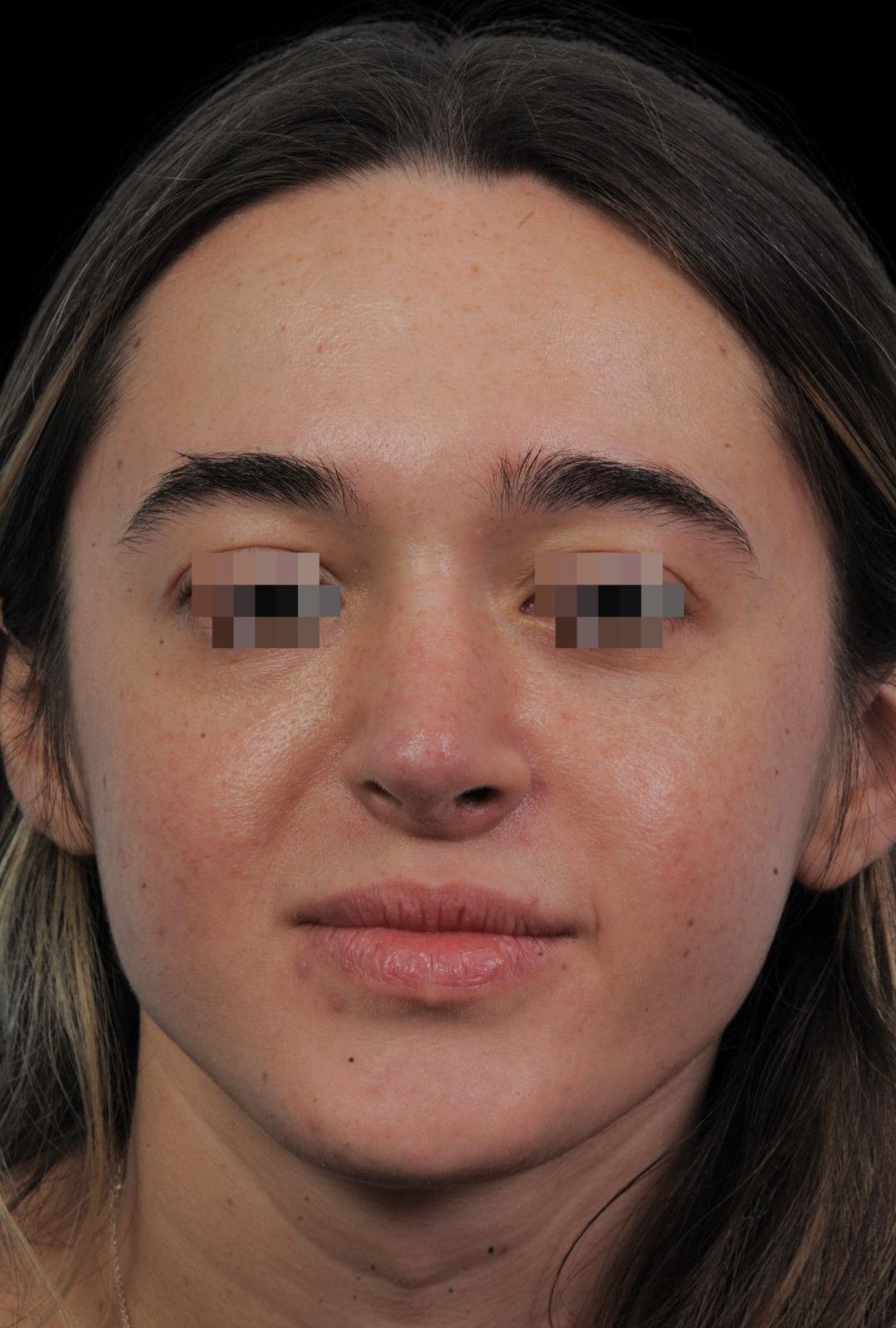 Photo of the patient’s face after the Rhinoplasty surgery. Patient 13 - Set 3