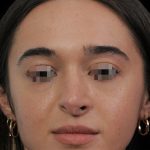 Thumbnail photo of the patient’s before the Rhinoplasty Patient 13