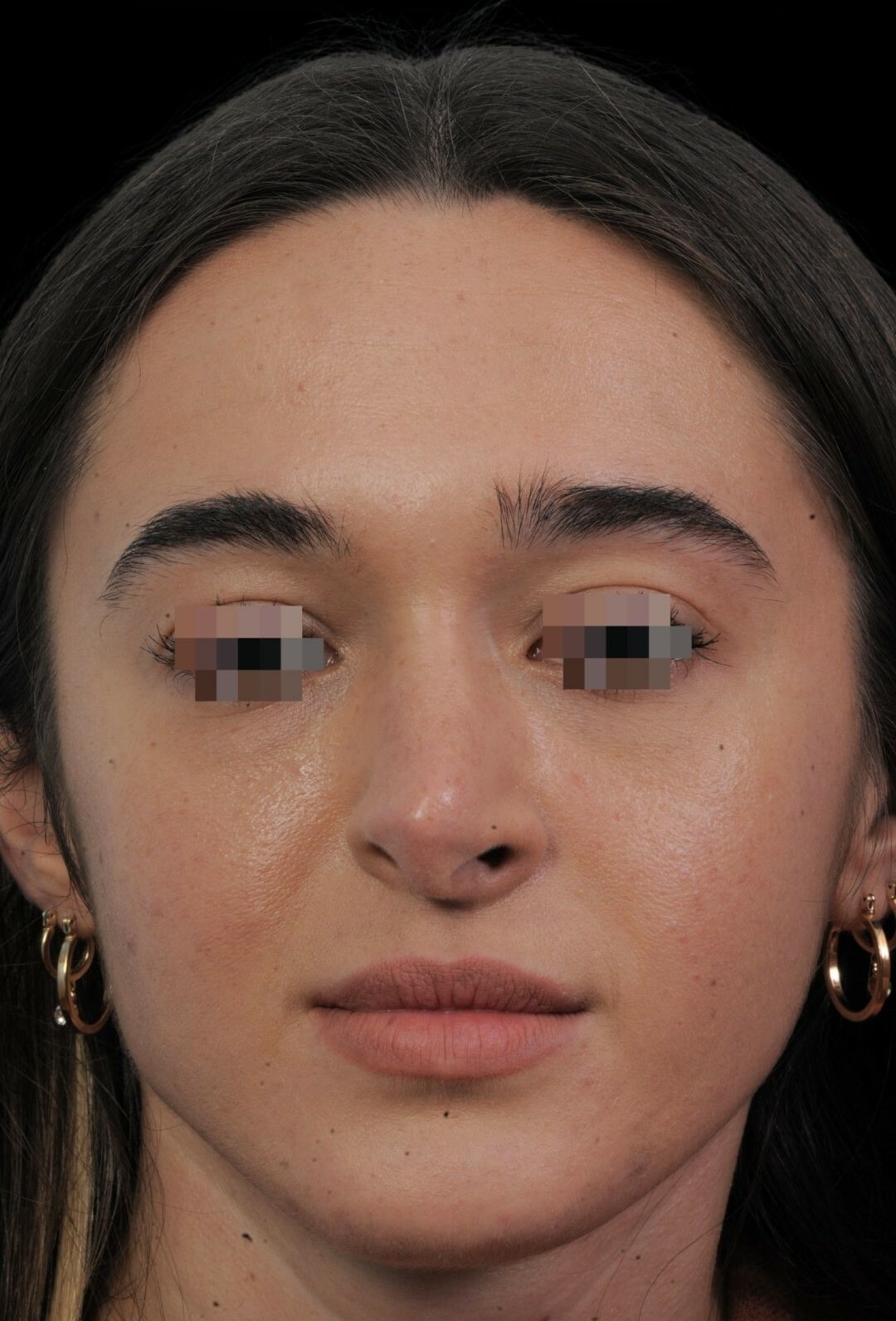 Photo of the patient’s face before the Rhinoplasty surgery. Patient 13 - Set 3