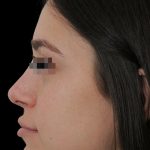 Thumbnail photo of the patient’s after the Rhinoplasty Patient 14