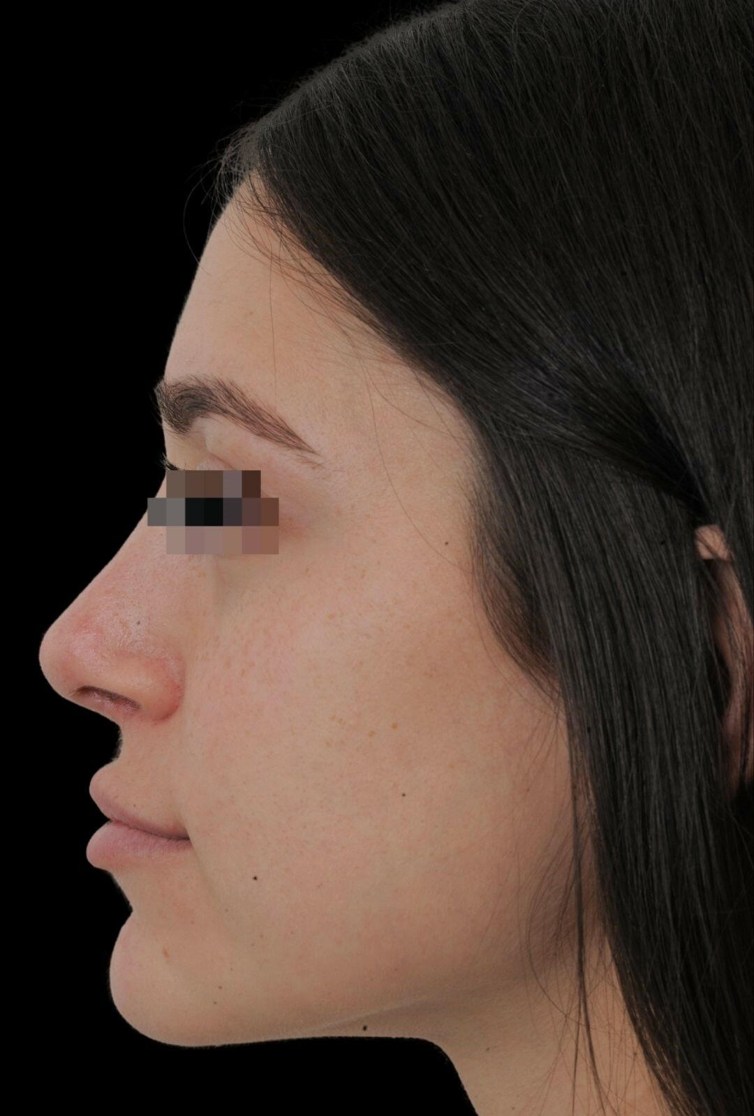 Photo of the patient’s face after the Rhinoplasty surgery. Patient 14 - Set 2