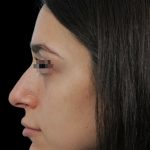 Thumbnail photo of the patient’s before the Rhinoplasty Patient 14