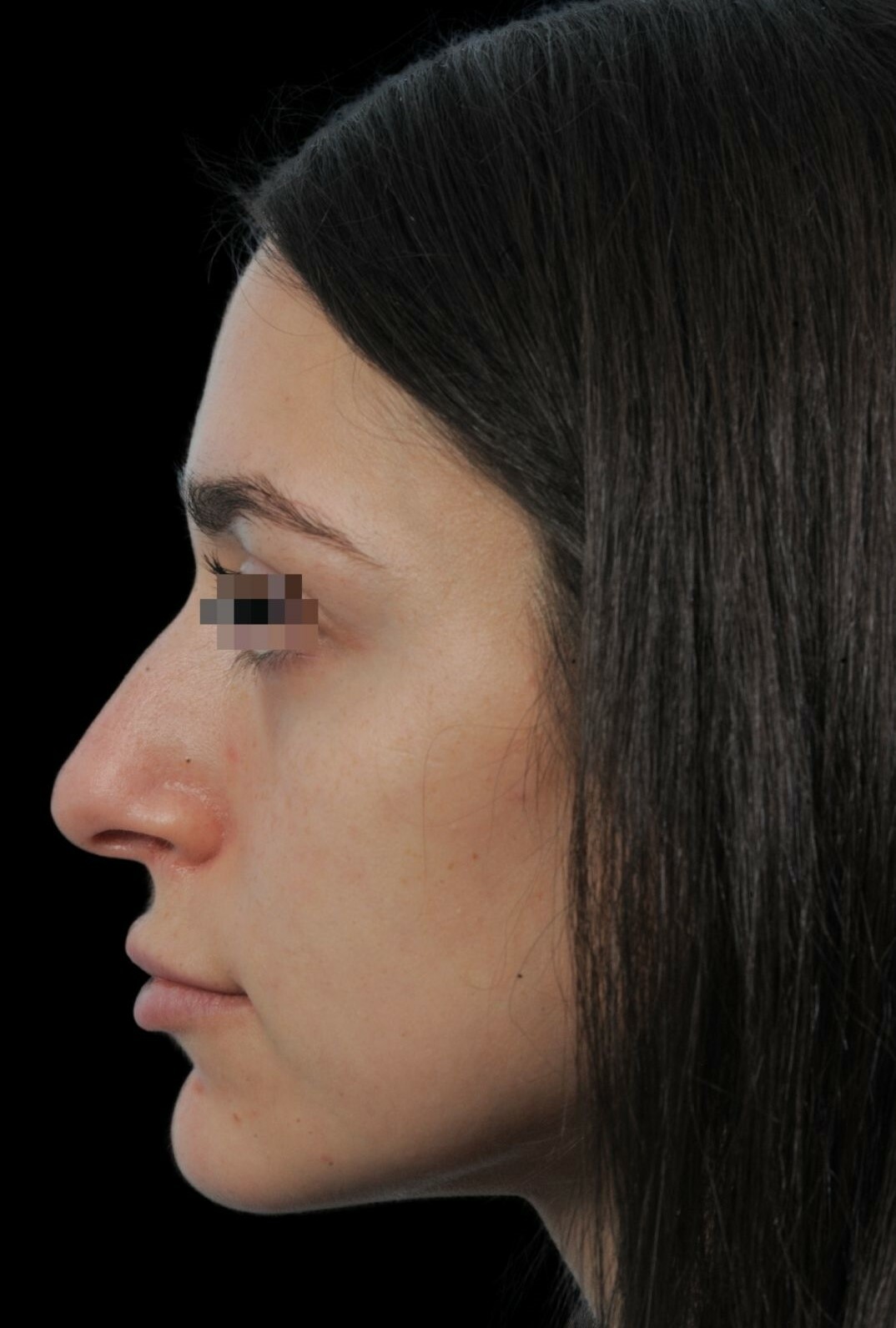 Photo of the patient’s face before the Rhinoplasty surgery. Patient 14 - Set 2