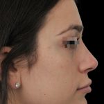 Thumbnail photo of the patient’s after the Rhinoplasty Patient 14