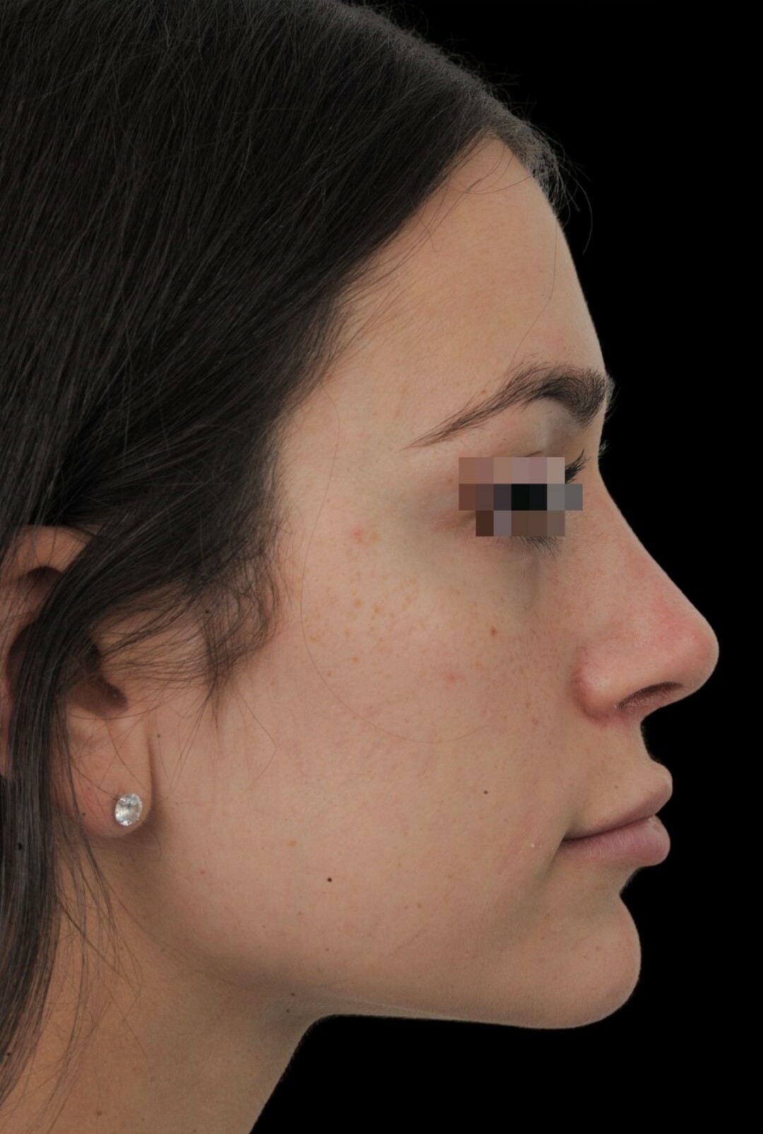 Photo of the patient’s face after the Rhinoplasty surgery. Patient 14 - Set 1