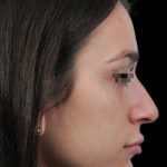 Thumbnail photo of the patient’s before the Rhinoplasty Patient 14