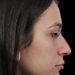 Photo of the patient’s face before the Rhinoplasty surgery. Patient 14 - Set 1