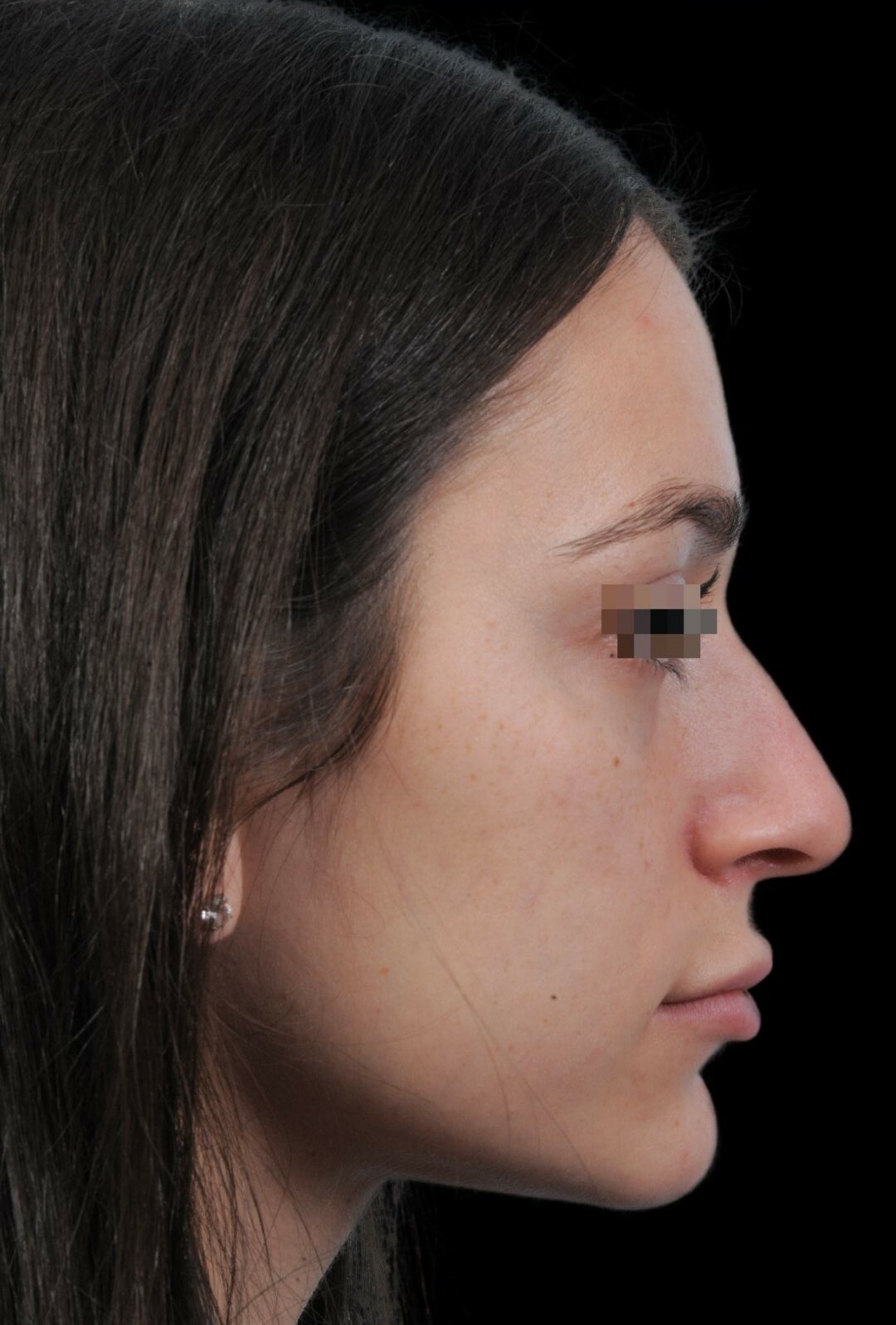 Photo of the patient’s face before the Rhinoplasty surgery. Patient 14 - Set 1