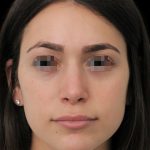 Thumbnail photo of the patient’s after the Rhinoplasty Patient 14