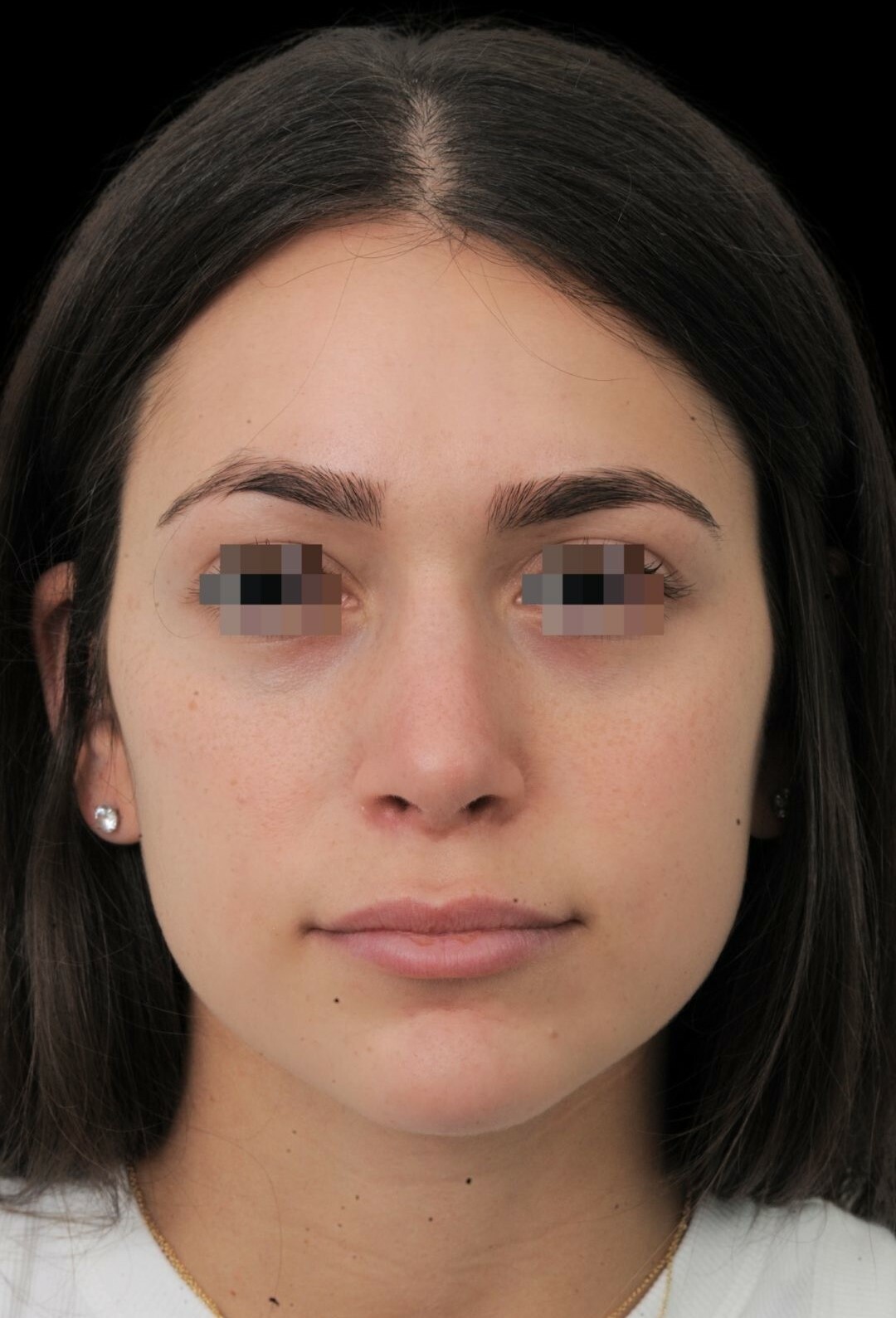 Photo of the patient’s face after the Rhinoplasty surgery. Patient 14 - Set 3