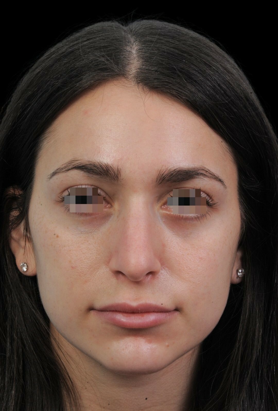 Photo of the patient’s face before the Rhinoplasty surgery. Patient 14 - Set 3