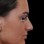 Photo of the patient’s face before the Rhinoplasty surgery. Patient 15 - Set 1