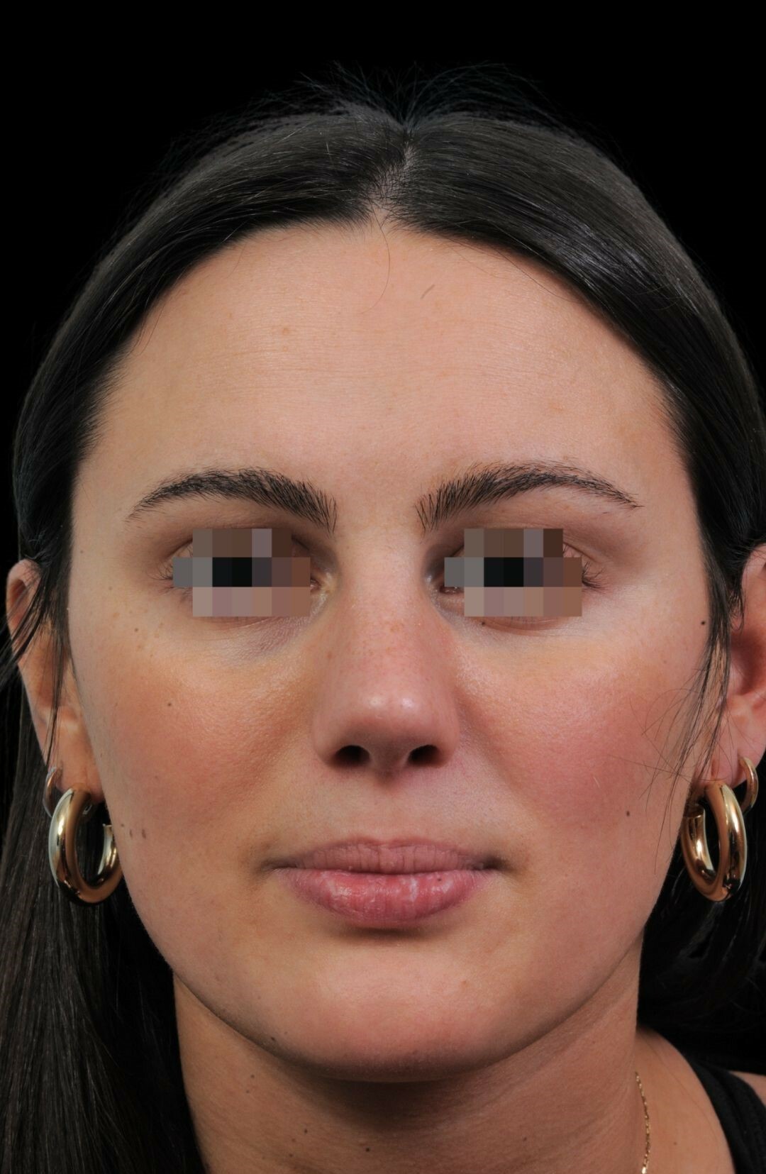 Photo of the patient’s face after the Rhinoplasty surgery. Patient 15 - Set 3
