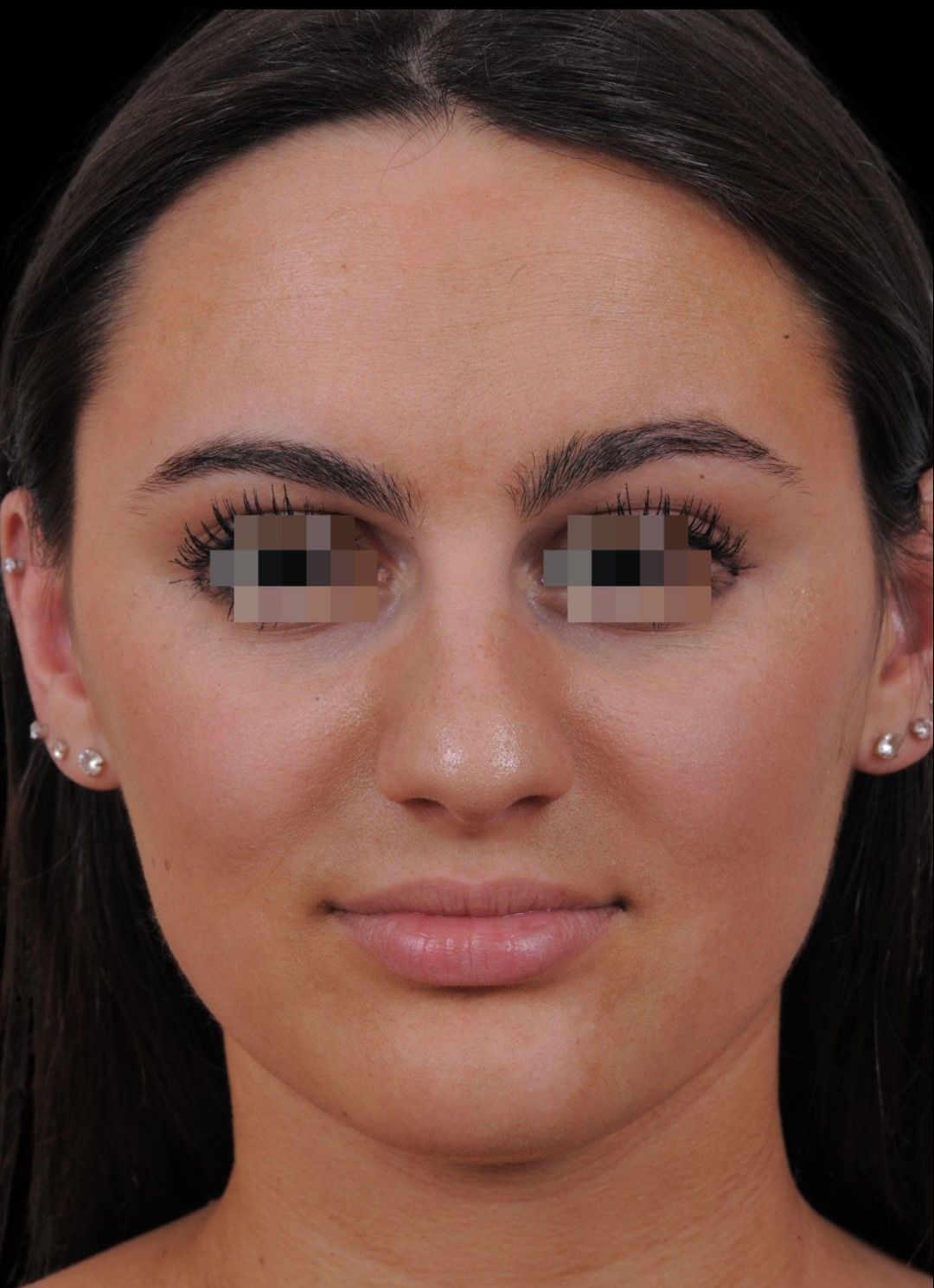 Photo of the patient’s face before the Rhinoplasty surgery. Patient 15 - Set 3