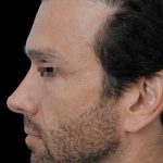 Thumbnail photo of the patient’s after the Rhinoplasty Patient 3