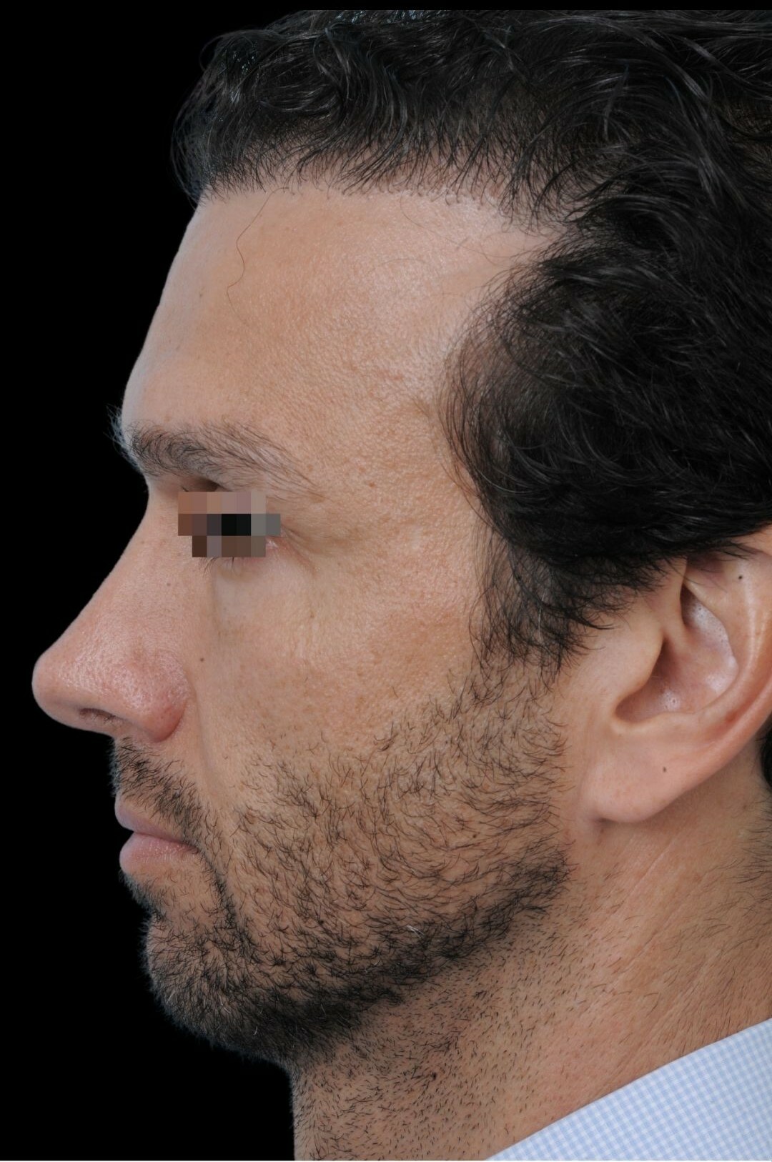 Photo of the patient’s face after the Rhinoplasty surgery. Patient 3 - Set 2
