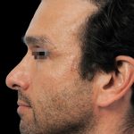 Thumbnail photo of the patient’s before the Rhinoplasty Patient 3